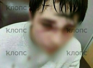 Подросток из пригородного посёлка Калининграда получил травмы в школьной драке