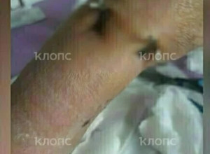 В Калининграде 66-летняя женщина получила открытый перелом руки после столкновения с самокатчицей на улице Горького