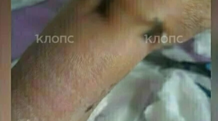 В Калининграде 66-летняя женщина получила открытый перелом руки после столкновения с самокатчицей на улице Горького