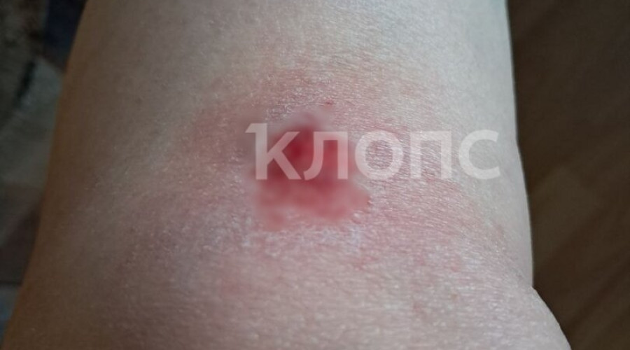 В Калининграде женщина пострадала из-за неисправной тактильной плитки на остановке