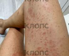 Жительница Калининграда получила аллергию после велопрогулки по Куршской косе