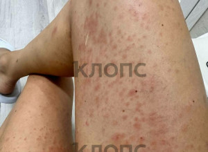 Жительница Калининграда получила аллергию после велопрогулки по Куршской косе