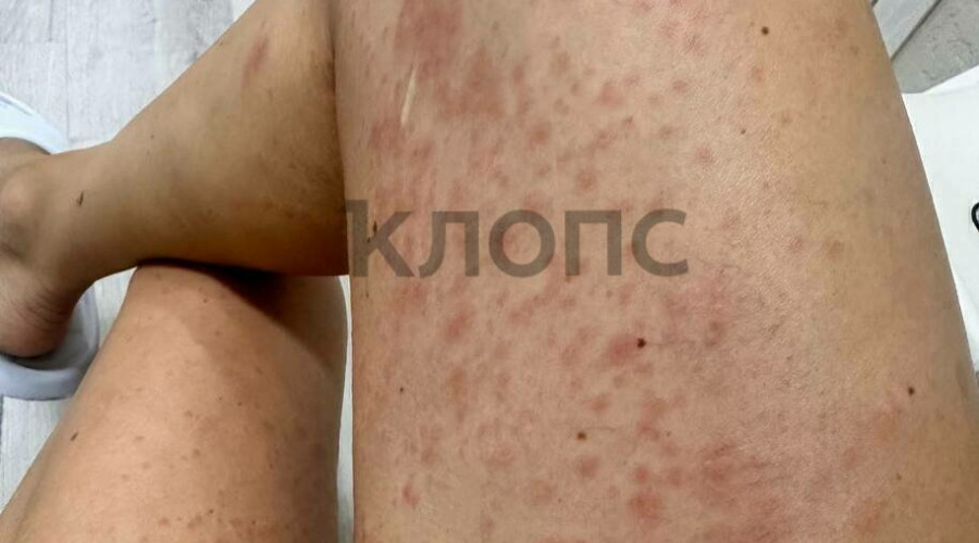 Жительница Калининграда получила аллергию после велопрогулки по Куршской косе